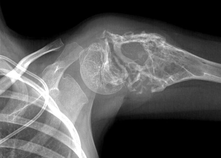 Метастазы в кости срок жизни. Метастазы в плечевой кости. Саркома плечевой кости рентген. Метастазы плечевой кости рентген.