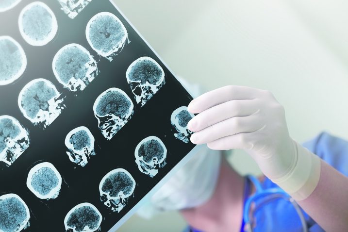 Epilepsija je postala bolest koja se može dobro liječiti i kontrolirati / Foto ISTOCK