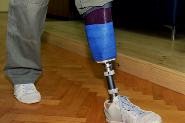 Suvremene proteze omogućuju veću pokretljivost / Foto Arhiva NL