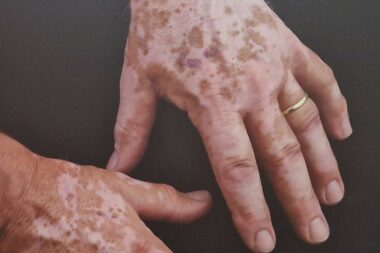 Vitiligo u Hrvatskoj ima oko 45 tisuća ljudi raznih dobi / Foto : ARHIVA GI