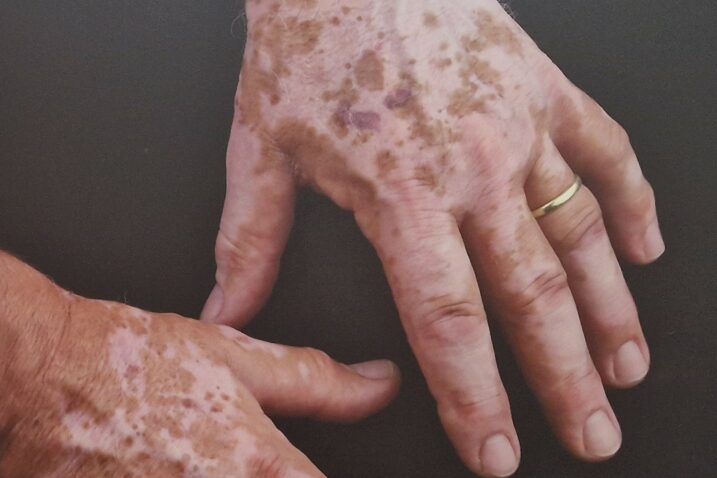 Vitiligo u Hrvatskoj ima oko 45 tisuća ljudi raznih dobi / Foto : ARHIVA GI