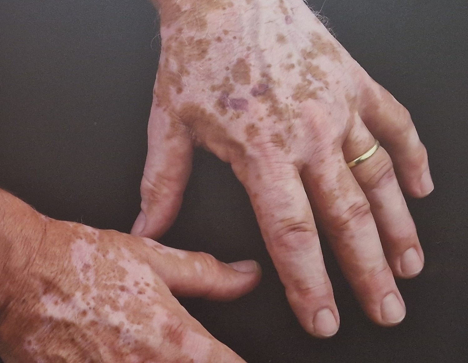 Vitiligo u Hrvatskoj ima oko 45 tisuća ljudi raznih dobi / Foto : ARHIVA GI
